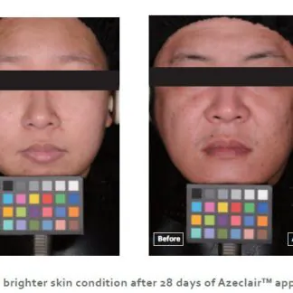 Крем з азелаїновою кислотою 15% та ніацинамідом AZELAIC CREAM