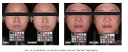 Крем з азелаїновою кислотою 15% та ніацинамідом AZELAIC CREAM - Зображення 2