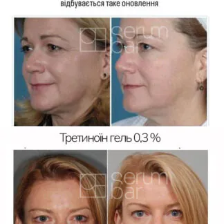 Набір TRE THERAPY з потужним ретинолом