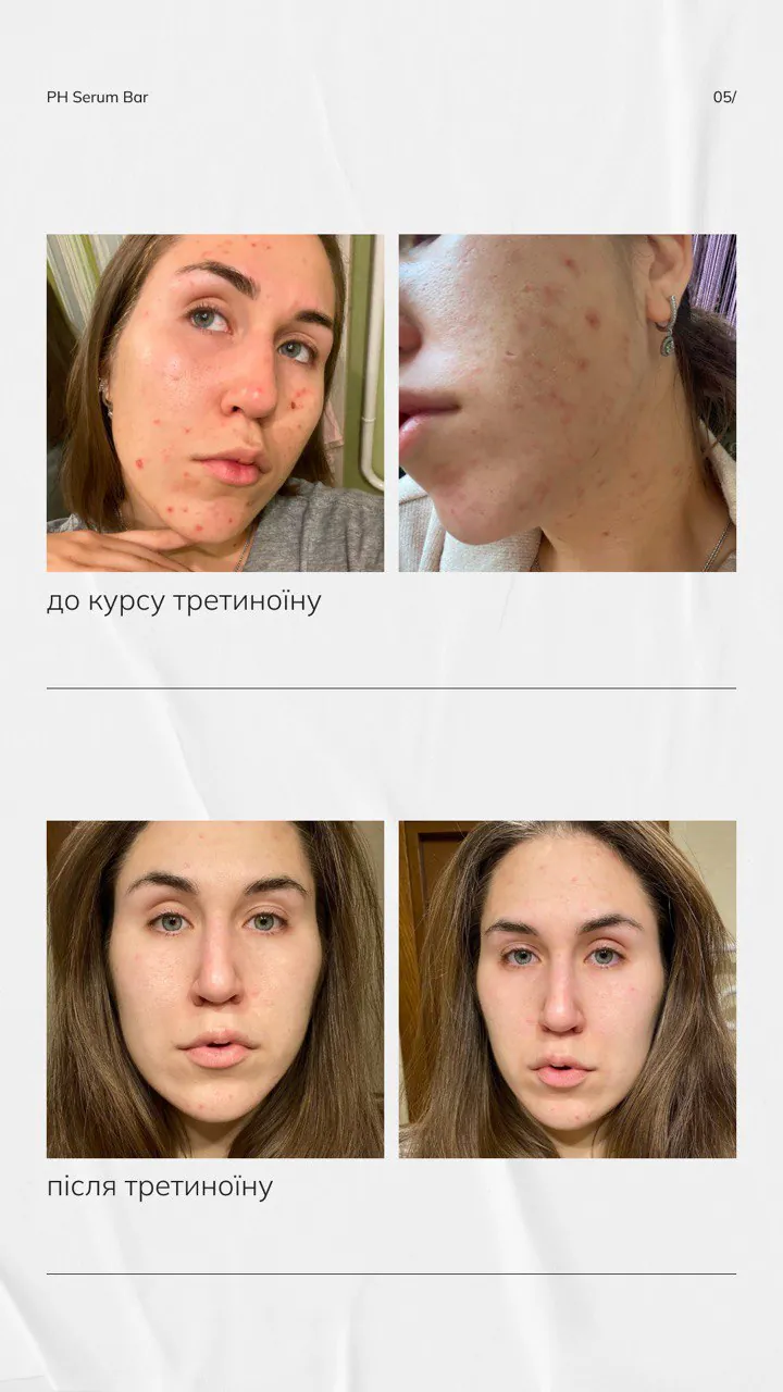 Набір TRE THERAPY з потужним ретинолом - Зображення 5